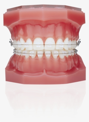Ceramic Braces Vs Invisalign #2148258