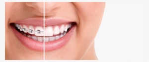 Woman Smiling Braces No Braces - Dental Braces #2148422