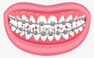 Braces And Aligners - Braces Cartoon No Background #2149099