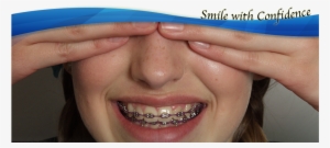 Life With Braces - Close-up #2149191