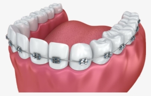 Braces - Dental Braces #2149278