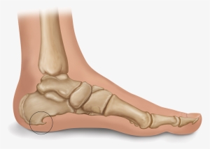 Heel Spur Illustration - Heel Spur #2189315