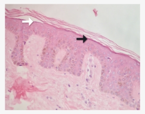 Pigmentación Uniforme De La Capa Basal, Hiperqueratosis - Painting #220672