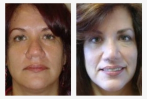 Nose Surgery Before & After Photos - Girl #221299