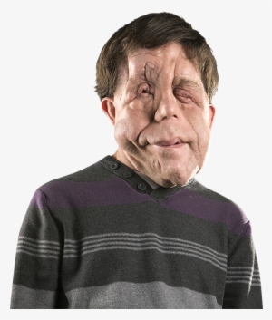 Film Blog Disfigured Heroes Like Deadpool Help People - Adam Pearson #2201235