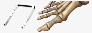 Charlotte™ Quick Staple - Bunion #2261771
