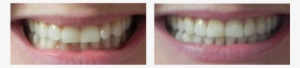 Before And After Orthodontics Treatment Case - Dental Braces #2272659
