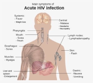 Nwo's The Club Of Rome, Genocide And You - Hiv Aids Virus Symptoms #2273734