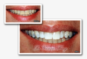 White Teeth Png Index Of - Tooth Whitening #2273861