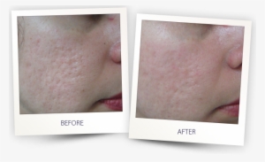 Legato Laser For Acne Scars #2284116