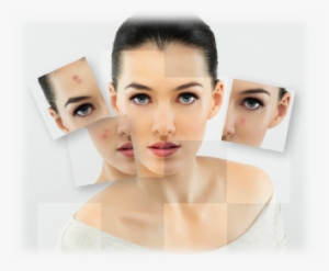 Break Free From Acne #2284564