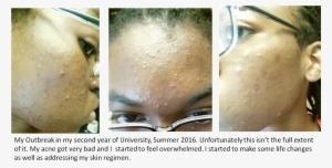 Second Year Acne Before - Acne #2284740