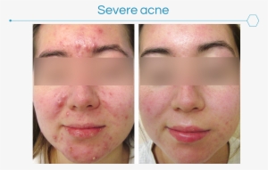 Acne Can Be Very Frustrating To The Patient And Have - Acne #2284780