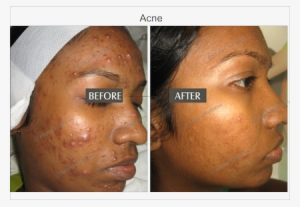 Acne And Marks - Acne #2284832