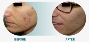 Active Acne/acne Scars - Stretch Marks Before And After #2284884