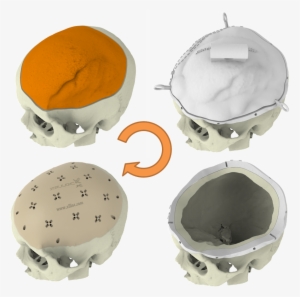 Meningioma 1 Stage - Cake #230743