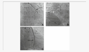 Preoperative Coronary Angiogram - Coronary Catheterization #2330756
