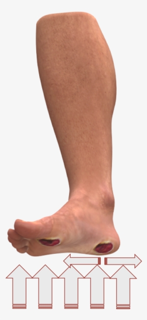 Physical Causes Of Diabetic Foot Ulcers - Diabetic Foot Ulcer #2373730