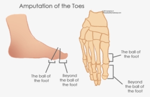 The Foot 11 - Partial Toe Amputation #2373901