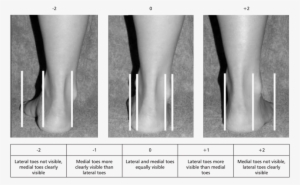 The Evaluation Of The Abduction/adduction Of The Forefoot - Foot Adduction #2373933 The Evaluation Of The Abduction/adduction Of The Forefoot - Foot Adduction #2373933