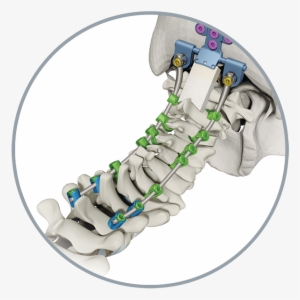 Atec Spine Products Solanas Featured Image - Nuvasive Vuepoint #2383188