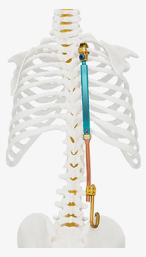 Veptr Ii Vertical Expandable Prosthetic Titanium Rib - Vertical Expandable Prosthetic Titanium Rib Veptr #2383267