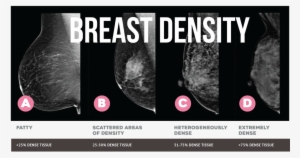 A Rather Convincing Estimation Of Breast Density Can - You Will Be More Disappointed #2387343