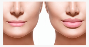 Relleno Labios - - 0.5 Ml Lips Before And After #2390931