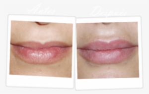 Aumento De Labios Cirugia - Surgery #2391054