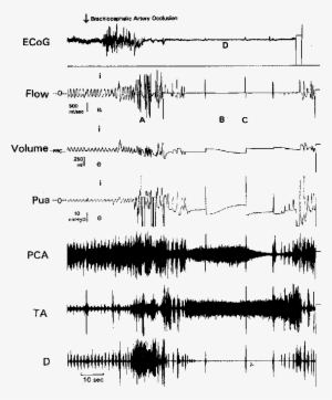 This Time Trace Of Ecog, Airflow, Volume, Pua, And - Sheet Music #2407017