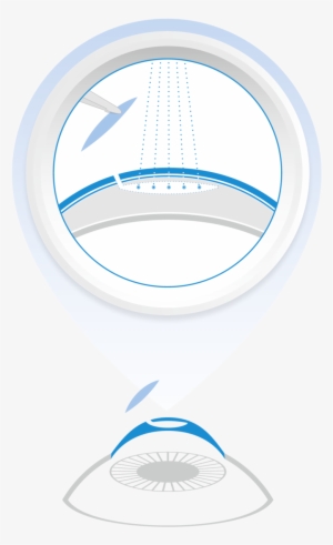 The New, Third-generation Smile Laser Surgery Unites - Circle #253819