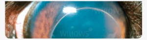 Lens Luxation - Cat #2525826