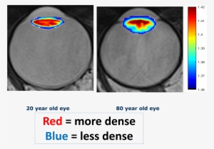 Images Of The Eye Under Mri - Microsoft Office 2003 #2549336