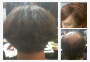 For A Person With Medical Conditions Such As Alopecia, - Lace Wig #2573931