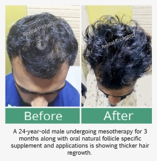 Hair Loss In Men - Lace Wig #2574240