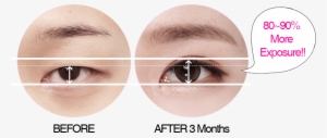 What Is Da's Ptosis Correction - Eye Shadow #2591574