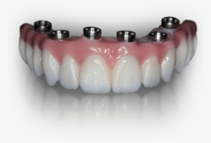 Prettau Zirconia - Teeth In A Day #268910