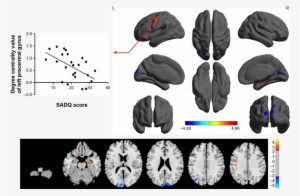 Between-group Differences In Binarized Degree Centrality - Superior Temporal Gyrus #2606471