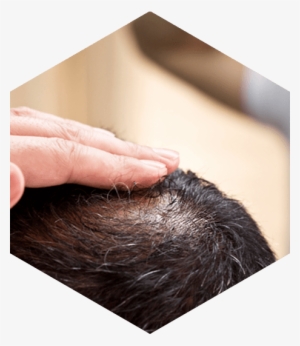 Causes Of Hair Loss In Men - Hair Loss #2615310