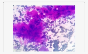 Clusters Consisting Of Tumor Cells With Spindle Cell - Spindle Cell Carcinoma #2663493