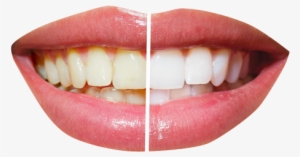Teeth Whitening Png Transparent Image - Dentistry Before And After #277370