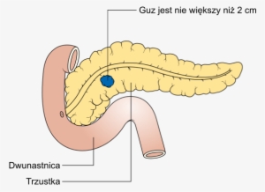 Diagram Showing Stage T1 Cancer Of The Pancreas Cruk - Rak W 4 Stadium #2728231