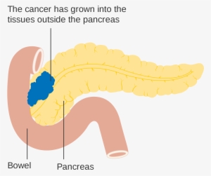 Open - Pancreas Diagram Png #2728233