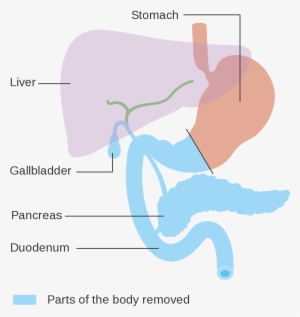 Total Pancreatectomy #2728834