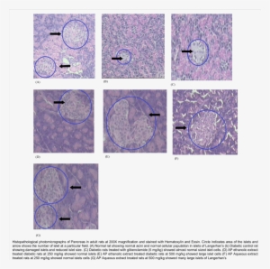 Histopathological Photomicrographs Of Pancreas - Diabetes Mellitus #2728927