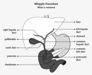 Diagram Of What Is Removed In A Whipple Procedure - Biliary Tree Diagram #2728945
