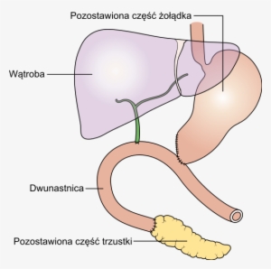 Diagram Showing How The Pancreas And Bowel Is Joined - Pancreatectomy #2728947