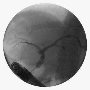 Dilation Of A Stricture With The Hurricane Rx Biliary - Hurricane Balloon #2737083
