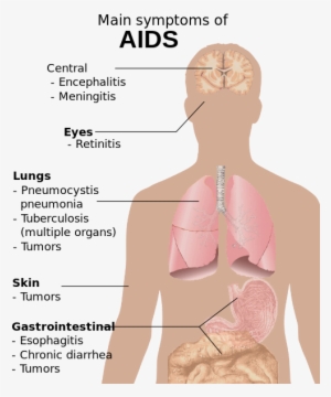 Symptoms Of Aids - Know If You Have Aids #2742387
