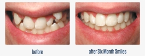 Gallery-07 - Before And After Six Month Smiles #2748726